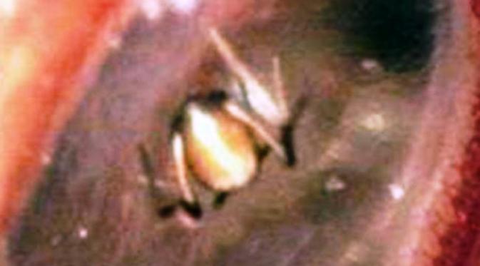 Laba-laba menghuni telinga seorang perempuan China (CEN/Australscope)
