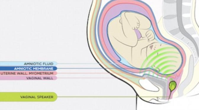 Diagram ini menunjukkan suara yang dimainkan intravaginal kepada janin. (Foto: Institut Marques)