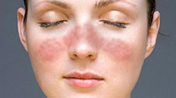 7 Fakta Tentang Penyakit Lupus yang Mungkin Belum Kamu Ketahui | via: tophealthideas.com