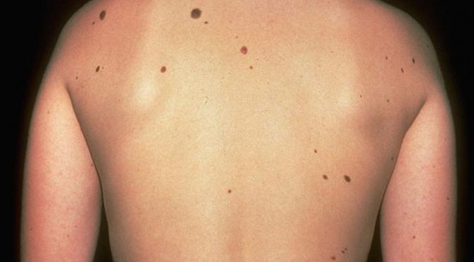 Pada laki-laki, tahi lalat juga bisa berpotensi timbul risiko kanker kulit. (Via: wdish.com)