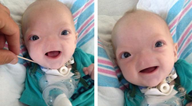 Eli, bayi yang terlahir tanpa hidung. | via: faithreel.com