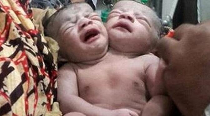 Kelahiran bayi berkepala dua ini buat publik Bangladesh heboh