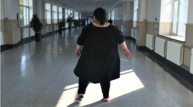 Seorang wanita seberat 240 kilogram yang berasal dari Changchun mendapatkan gelar ‘wanita paling berat di Tiongkok’ baru-baru ini menjalani bedah bypass lambung. (Sumber Shanghaiist.com)