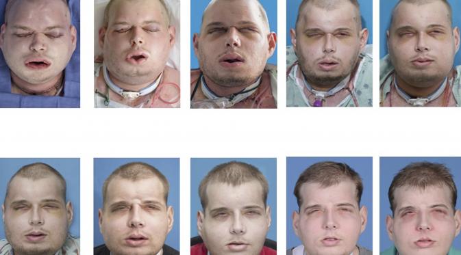 Perubahan wajah Patrick Hardison saat menjalani bedah plastik di Langone Medical Center NYU, New York, Amerika Serikat, (16/11/2015). Pria berusia 41 tahun tersebut menjalani operasi selama 95 hari. (REUTERS)