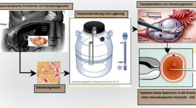 Ilustrasi prosedur pengawetan beku (cryopreservation) pada sel telur wanita. (Sumber offenbach-kinderwunsch.de)