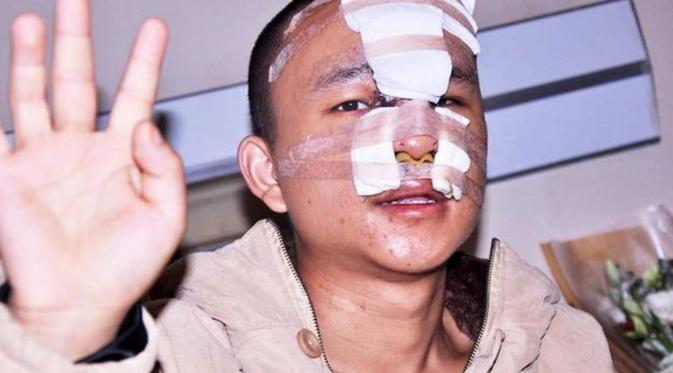 Li Ming setelah operasi tiga kali. (Via: mirror.co.uk)