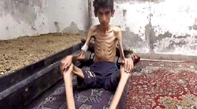 Tinggal tulang berbalut kulit, rupa anak Suriah perlihatkan parahnya kelaparan yang melanda. | via: AP