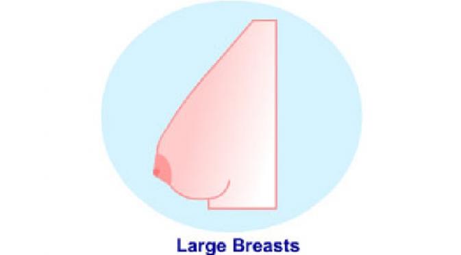 Large Breasts (sumber, medindia.net)