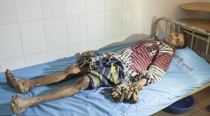 Abul Bajandar, laki-laki yang bernasb seperti Dede 'manusia akar'. | via: Zuma Wire/Rex/Shutterstock