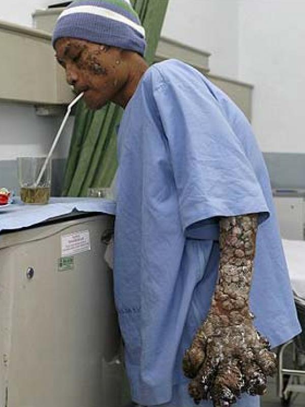 Dede 'manusia akar' setelah operasi di tahun 2008. | via: Telegraph