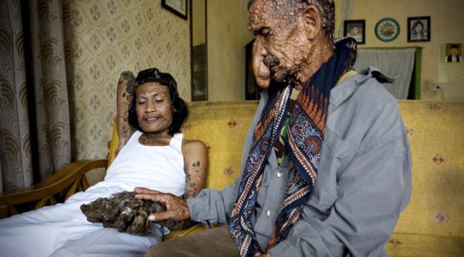 Dede 'manusia akar' bertemu dengan Sakim. (Getty Images)
