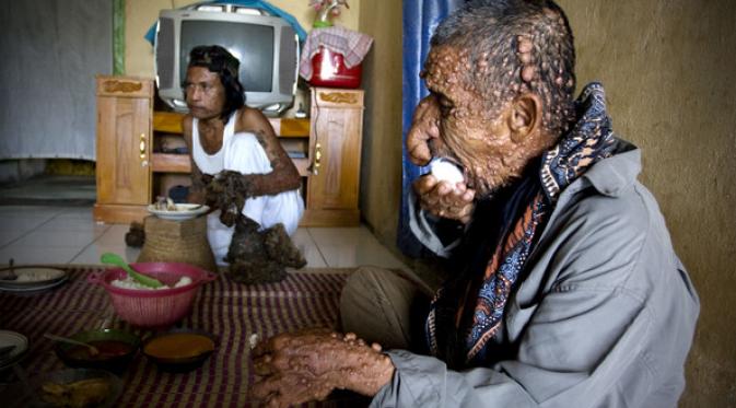 Dede 'manusia akar' bertemu dengan Sakim. (Getty Images)