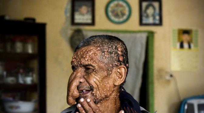 Sakim, penderita kondisi tubuh langka yang sempat menyambangi Dede 'manusia akar'. (Getty Images)