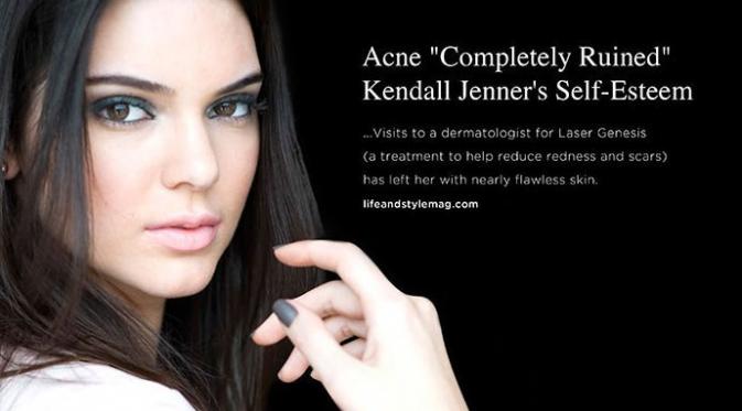 Iklan Cutera - Kendall Jenner (via aceshowbiz.com)