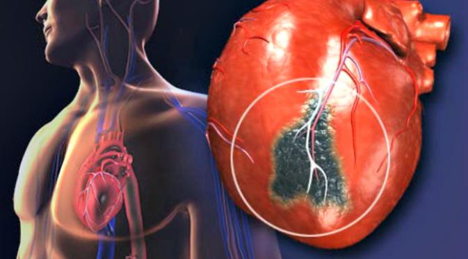 Ilustrasi atherosclerosis, penyumbatan pembuluh darah jantung. (Sumber webMD)