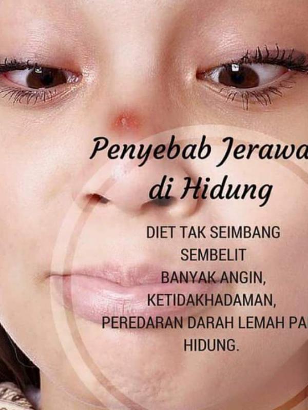 Tumbuhnya jerawat di wajah berpengaruh pada kesehatanmu | Via: facebook.com