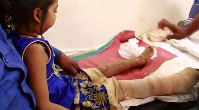 Kaki Manisha Patel dibebat dengan perban untuk mencegah infeksi parah. (Caters News Agency)