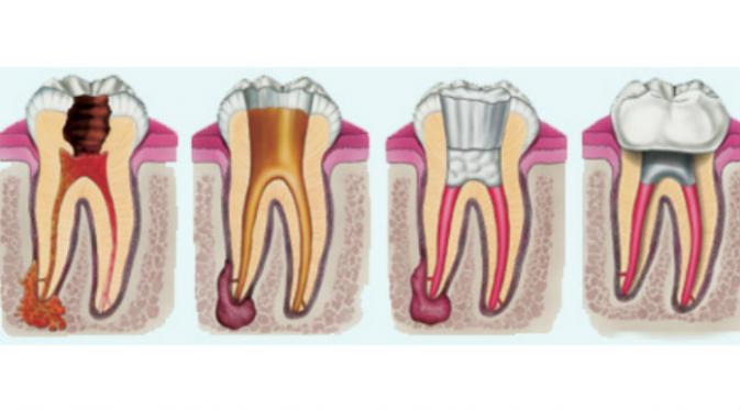 Perawatan endodontik modern sangat serupa dengan penambalan rutin dan biasanya dapat tuntas dalam sekali atau dua kali pertemuan,