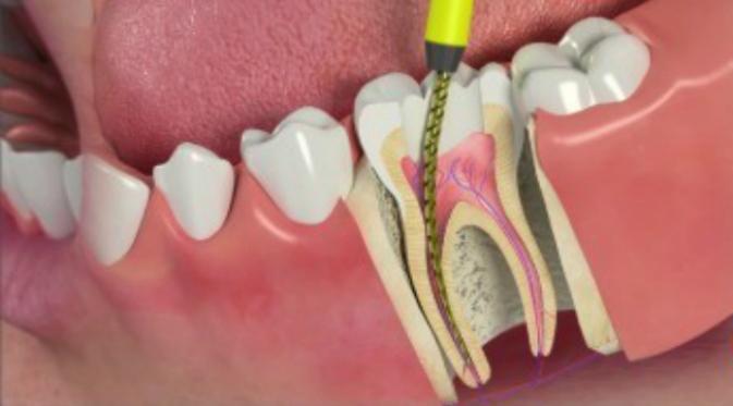 Ilustrasi perawatan saluran akar. Gigi dibuka bagian tengahnya, lalu jarum pembersih dimasukkan pada saluran akar yang terdampak untuk mencuil syaraf yang membusuk.(Sumber smileatlegacy.co.uk)