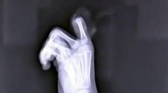 Hasil sinar x bocah yang memotong jarinya sendiri karena dilarang main 'smartphone'. (CEN)