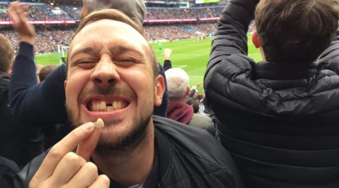 Seorang fan MU memperlihatkan gigi depannya yang tanggal lantaran terlalu bersemangat merayakan gol Marcus Rashford. (Metro)