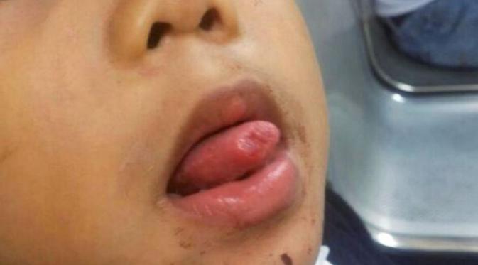 Bekas luka setelah bocah ini nekat memotong lidahnya di sekolah. | via: thestar.com.my