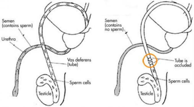 Vasektomi melibatkan pemutusan saluran vas deferens sehingga aliran sperma ke luar juga terputus. (Sumber parsemusfoundation.org)
