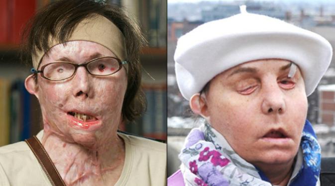 Carmen Tartleon harus menjalani transplantasi wajah setelah disiram air keras oleh mantan suaminya. (Sumber CNN)
