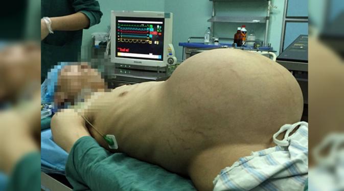 Seorang pria hidup selama 10 tahun dengan tumor hingga membelendung seperti ibu-ibu hamil. (dailymail)