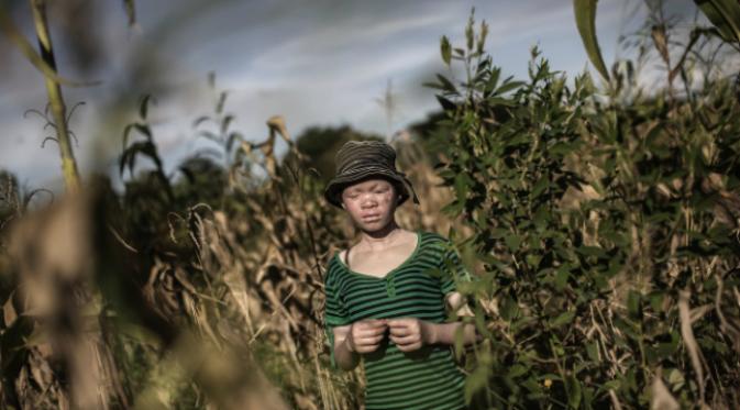 Catherine Amidu (12) adalah seorang remaja dengan albinisme di Malawi. Di sana, warga dengan albinisme kerap menjadi korban pembunuhan dan mutilasi terkait klenik. Foto di ladang diambil pada April 2015. (Sumber CBC.ca)