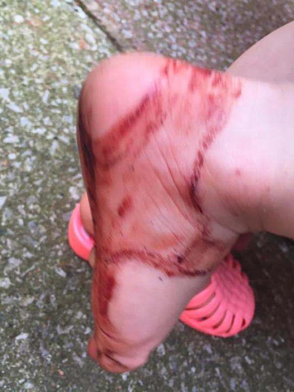 Pakai Sandal 'Jelly,' Kaki Bocah Ini Keluarkan Banyak Darah | via: thesun.co.uk