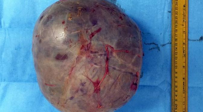 Wanita menderita tumor sebesar 7 kilo (Mirror.co.uk)