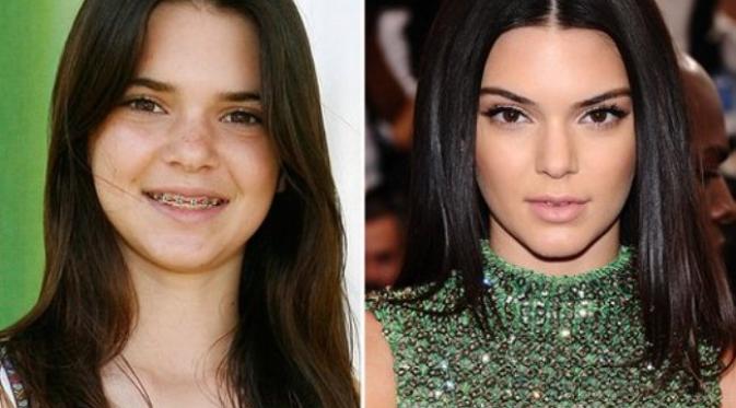 Perbandingan Kendall Jenner tahun 2007 dan sekarang. Sumber : tv.yahoo.com