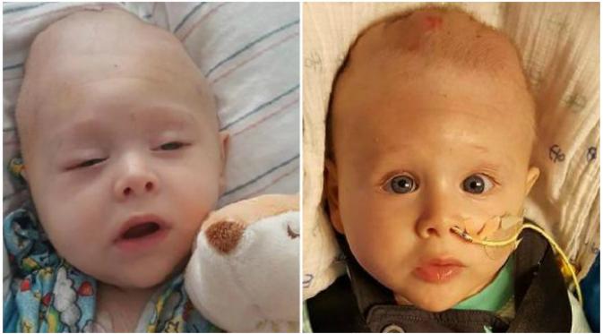 Suatu kondisi langka dialami seorang bayi yang lahir dengan otak berada di luar tengkoraknya. (Sumber Facebook via news.com.au)