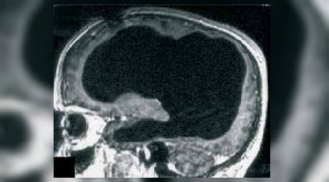 Seorang pria kehilangan 90 persen otaknya, tapi menjalani kehidupan yang normal. Bagaimana bisa? (Sumber Feuillet et al/The Lancet via Science Alert)