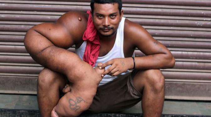 Bablu, lelaki asal India yang punya lengan seberat 20 kilogram. (Nagesh Ohal/Barcroft Media)