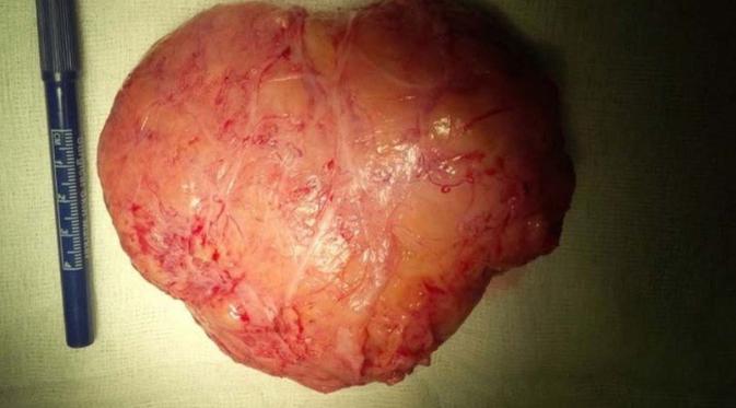 Ini tumor jinak yang berhasil dikeluarkan dari rahim Shorntay Allen, model lingerie asal London (foto: Mirror.co.uk)