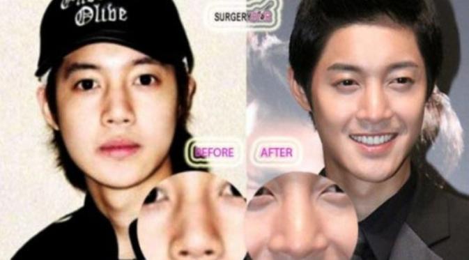 Hyun Joong nose surgery (Foto: celebritysurgerynews.com)