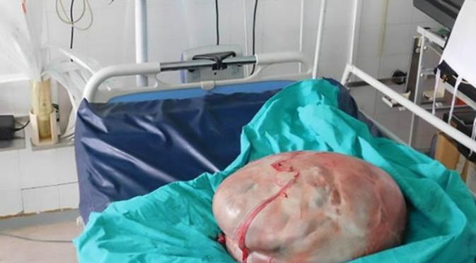 Tumor berbobot 30,8 kilogram yang diangkat dari perut seorang wanita (CEN)