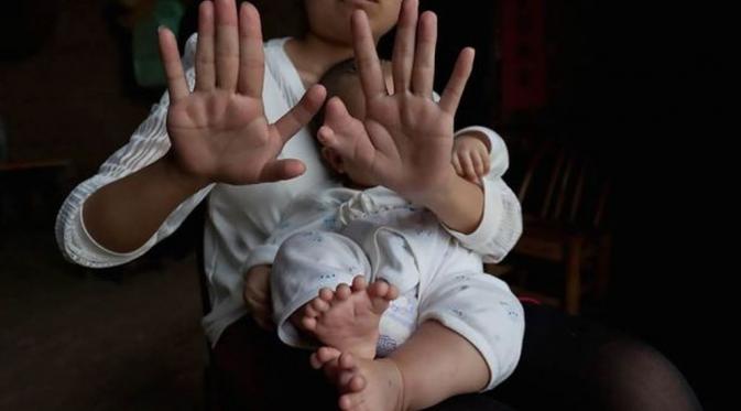Ibu dari bayi laki-laki yang mengalami kelebihan jari. (Via: mirror.co.uk)