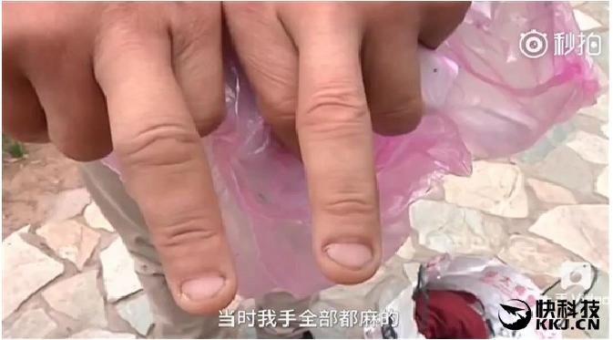 Selain melukai wajah, jari pria tersebut juga terluka karena ledakan iPhone 7 (Sumber: Tech Viral)
