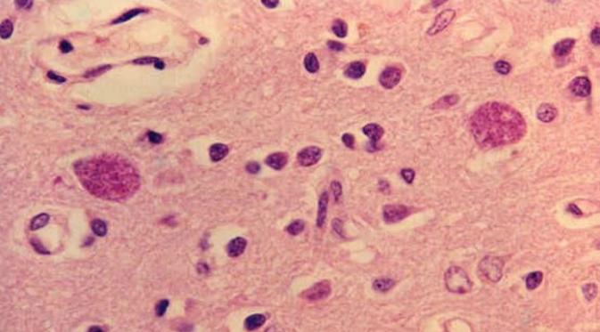Parasit Toxoplasma gondii dalam otak manusia.. (Sumber CDC/Jonathan W.M. Gold. M.D.)