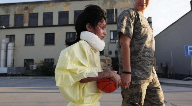 Razia, bocah yang terkena bom fosfor putih (Reuters)