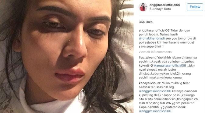 Wajah Anggita Sari mengalami lebam di pipi sebelah kanan. (via instagram.com/anggitasariofficial06)