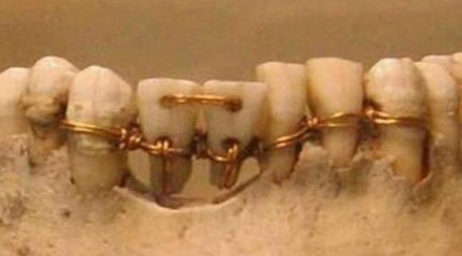 Gigi palsu pada mumi Mesir Kuno. Ternyata manusia purbakala sudah menggunakan gigi palsu untuk permasalan gigi mereka.(Sumber Ancient Origins)