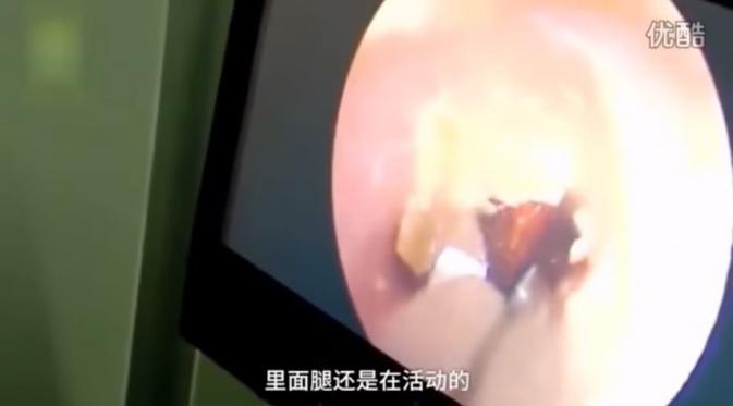 Proses pengambilan kecoak yang bersarang di dalam telinga Su. (Via: youtube.com)