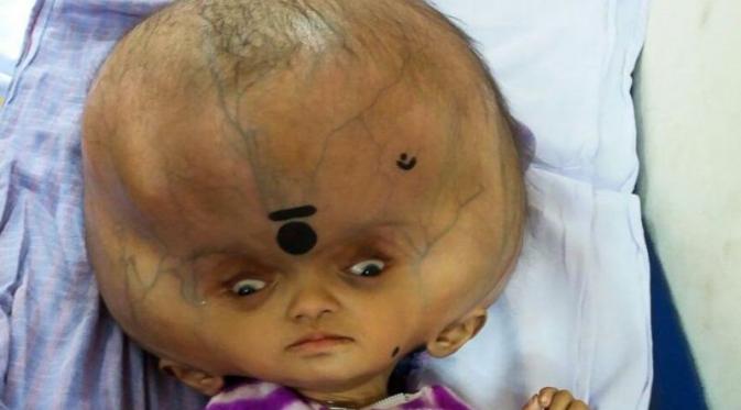 Menderita Hidrosefalus, Bayi Ini Miliki Kepala Terbesar di Dunia