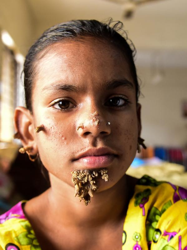 Sahana Khatun yang wajahnya ditumbuhi beberapa kutil menjalani perawatan di sebuah rumah sakit di Dhaka, Bangladesh, 30 Januari 2017. Gadis 10 tahun itu pun dianggap sebagai perempuan pertama di dunia yang memiliki kelainan "Tree Man Syndrome". (STR/AFP)