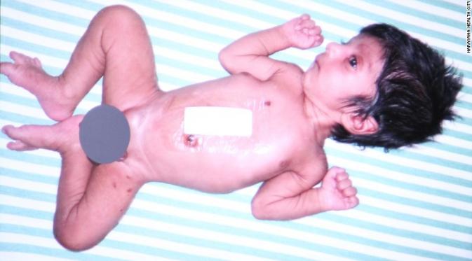 Bayi di India ini terlahir dengan kondisi fisik istimewa ( Narayana Health City)