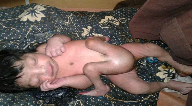 Bayi di India lahir dengan empat kaki dan dua penis. (Foto: Mail Online)
